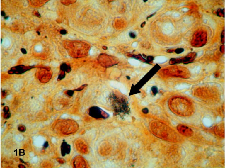 Bartonella quintana Bartonella quintana (Bartonella quintana)