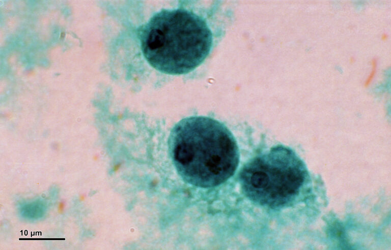 Entamoeba histolytica