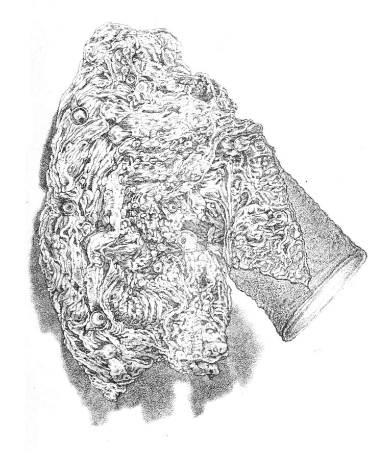 Gastrodiscoides hominis