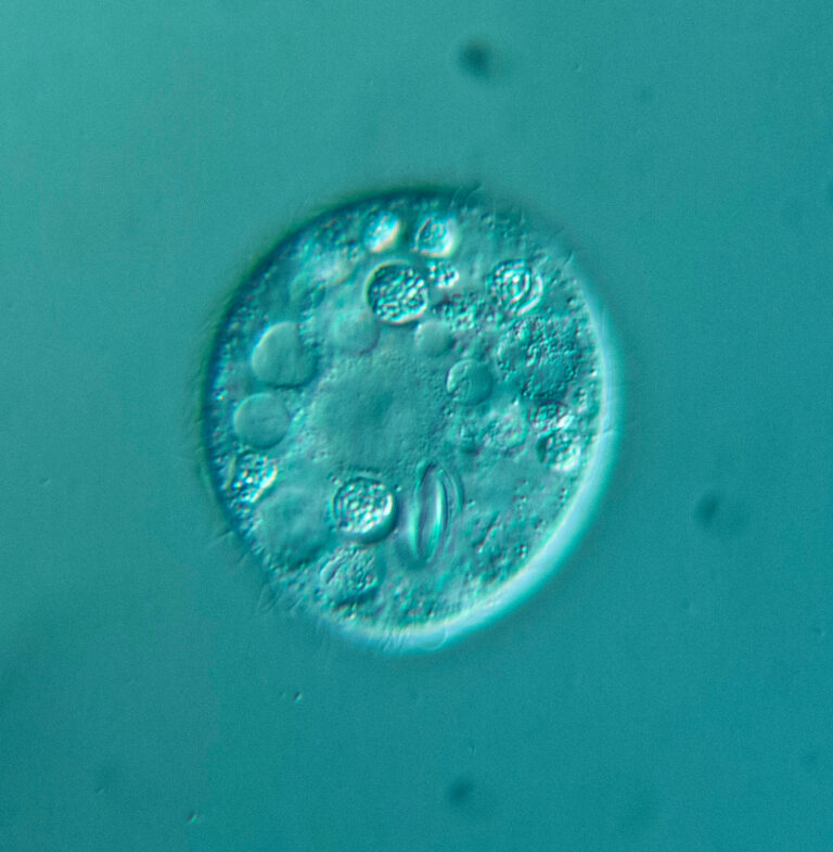 Glaucoma scintillans Glaucoma scintillans