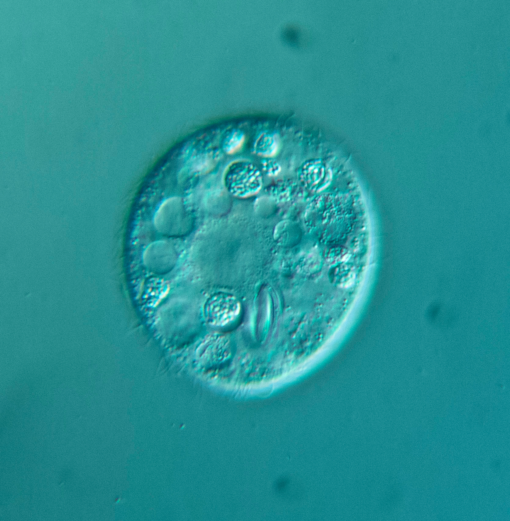 Glaucoma scintillans