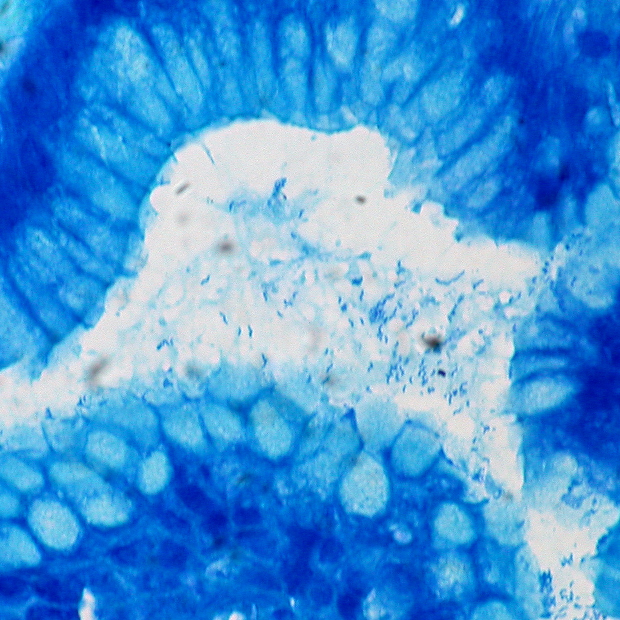Helicobacter pylori