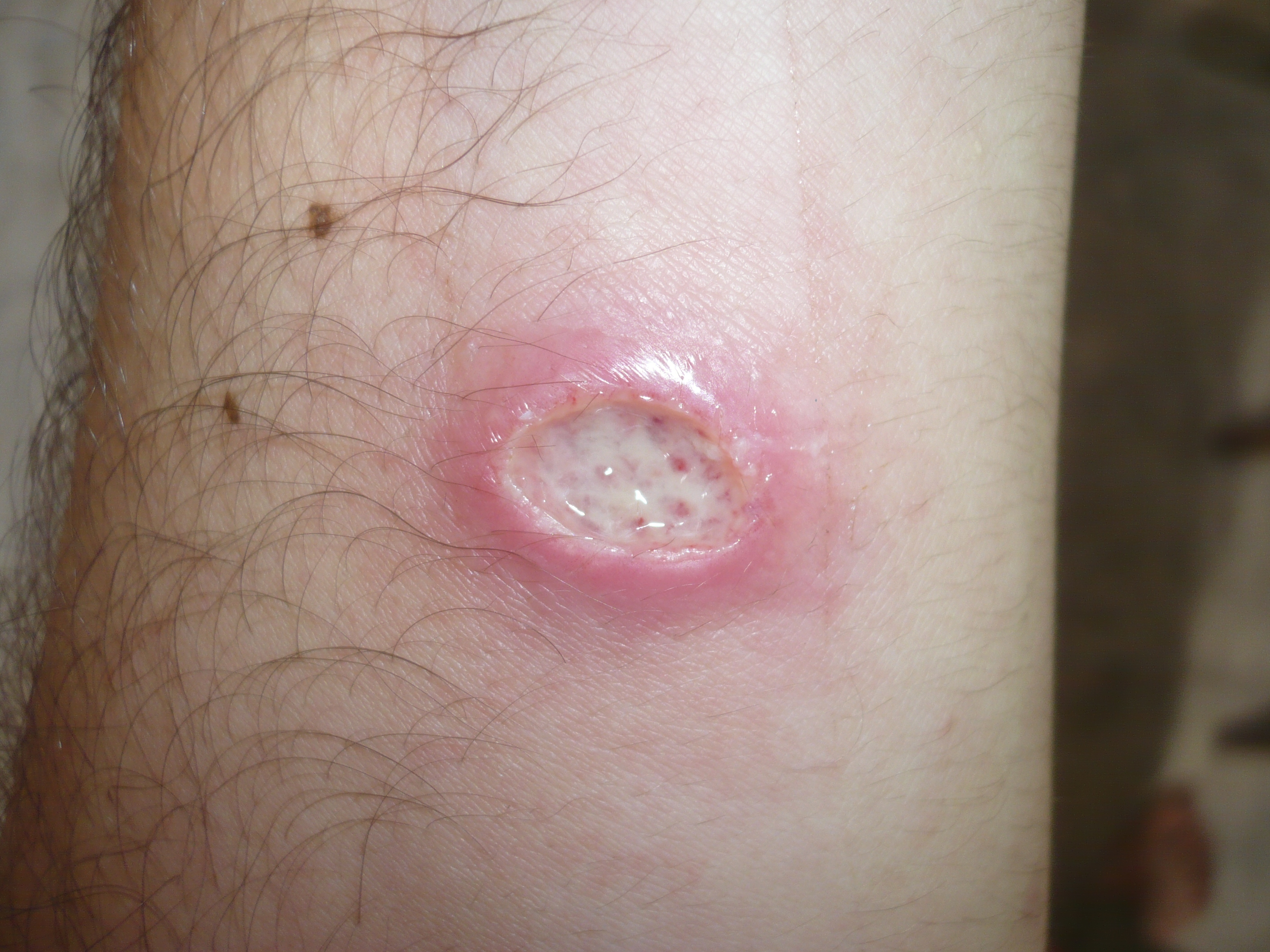 Leishmania braziliensis