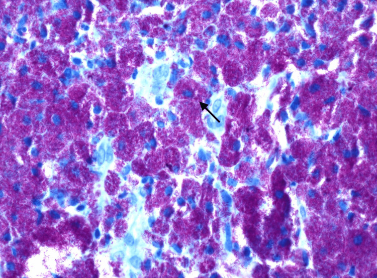 Mycobacterium avium
