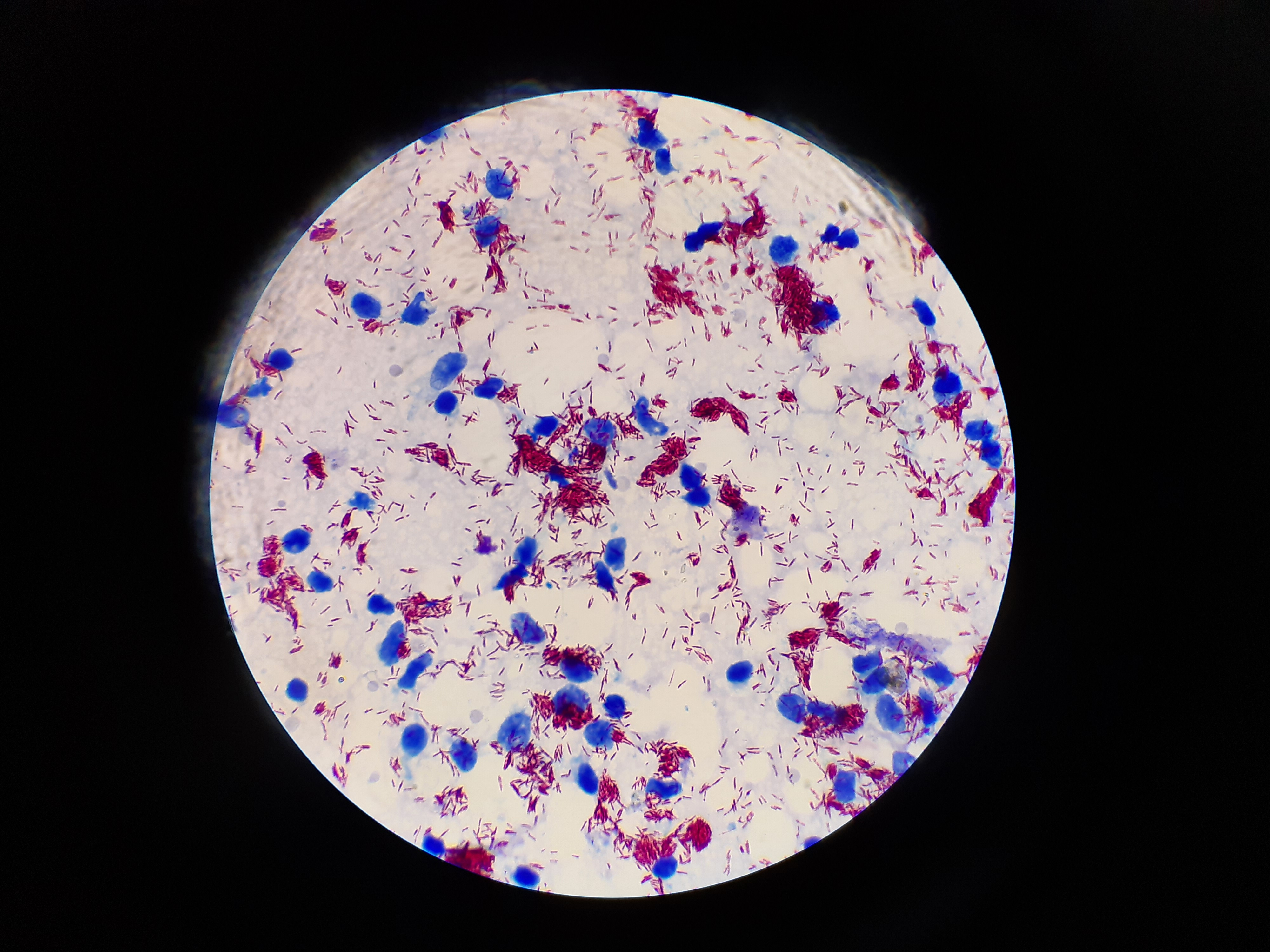 Mycobacterium leprae
