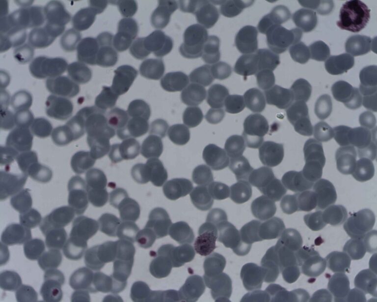 Plasmodium ovale