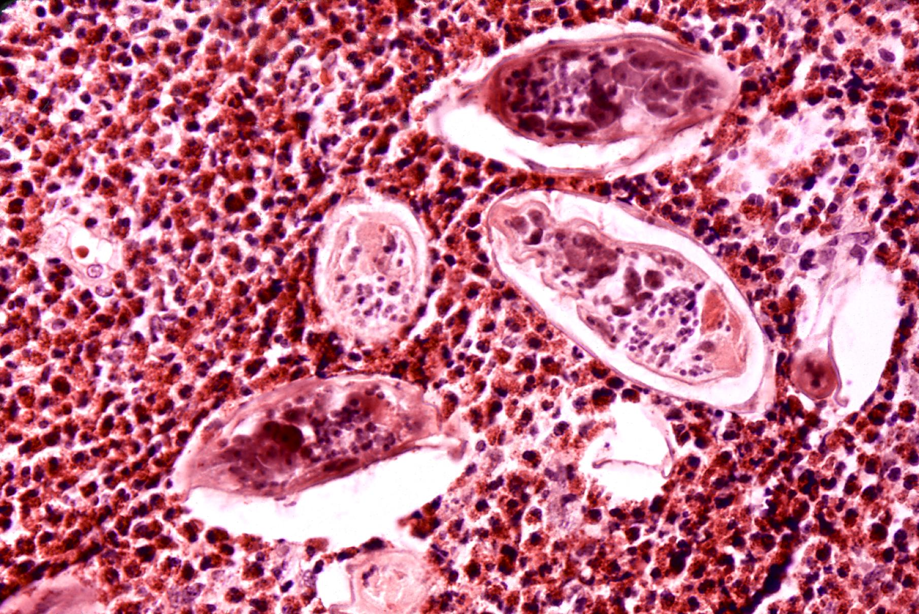 Schistosoma haematobium