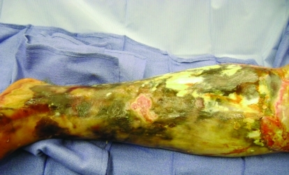 Vibrio vulnificus